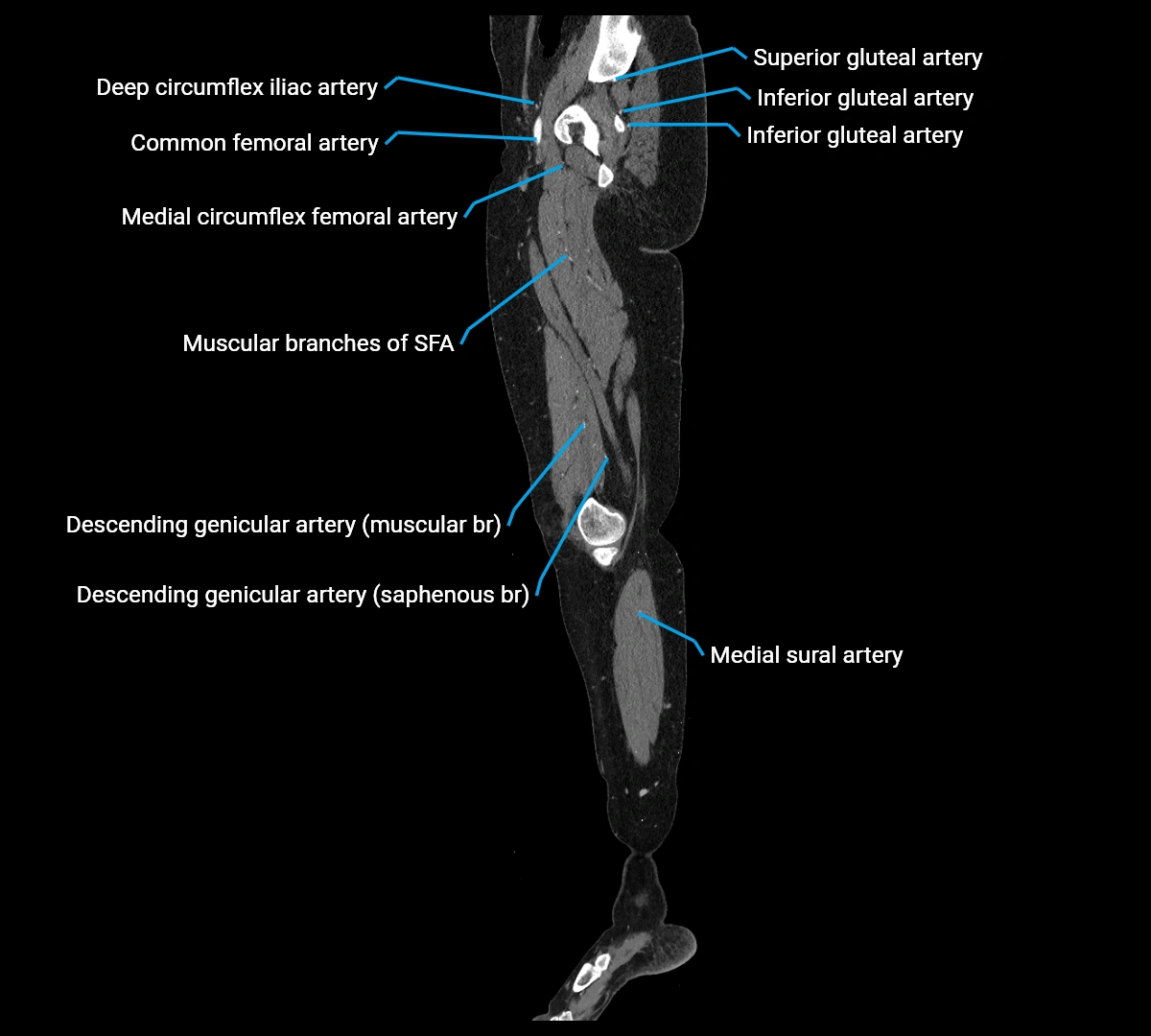 CTA lower limb sagittal cross sectional anatomy labelled image _26 (4).webp